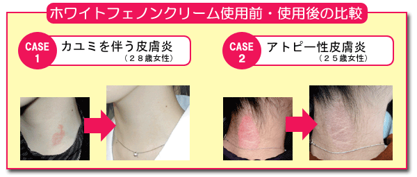 �z���C�g�t�F�m���N���[���g�p�O�E�g�p��̔�rCASE1�@�J���~�𔺂��畆���i�Q�W�Ώ����jCASE2�@�A�g�s�[���畆���i�Q�T�Ώ����j